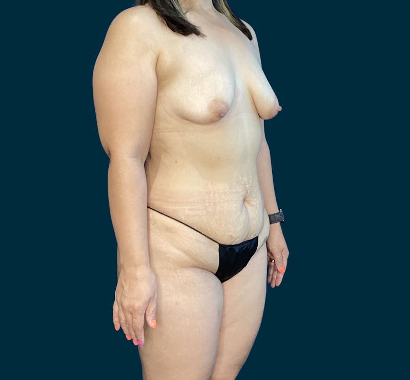 Liposuction Before & After Gallery - Patient 197043 - Image 1
