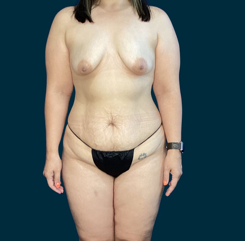 Abdominoplasty Before & After Gallery - Patient 269613 - Image 1