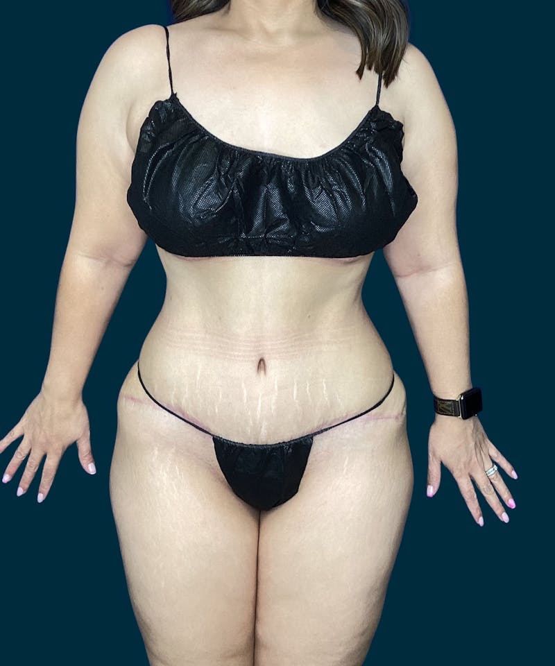 Abdominoplasty Before & After Gallery - Patient 269613 - Image 2