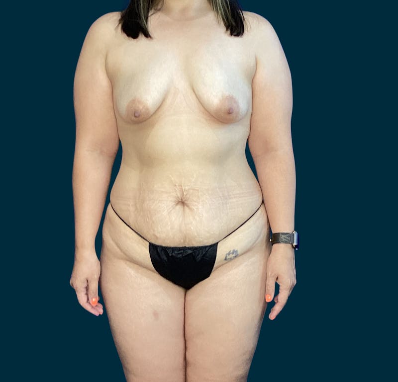 Liposuction Before & After Gallery - Patient 197043 - Image 5