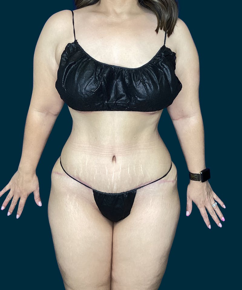 Liposuction Before & After Gallery - Patient 197043 - Image 6