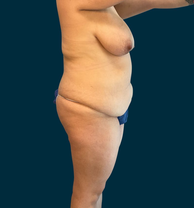 Liposuction Before & After Gallery - Patient 174445 - Image 1