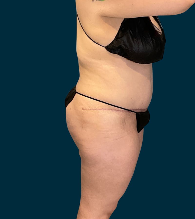 Liposuction Before & After Gallery - Patient 174445 - Image 2