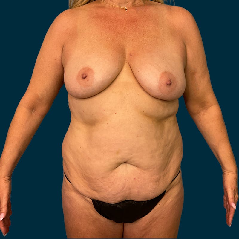 Breast Augmentation Before & After Gallery - Patient 112195 - Image 1
