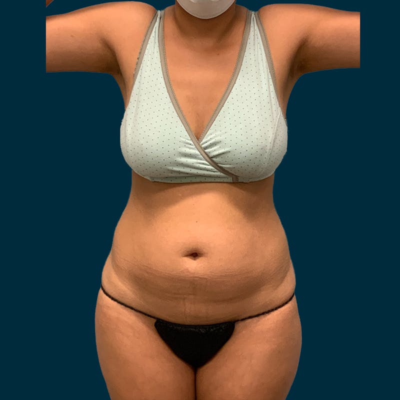 Liposuction Before & After Gallery - Patient 104078 - Image 1