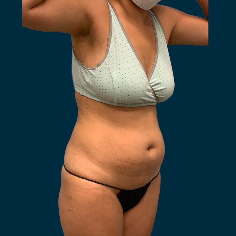 Liposuction Before & After Gallery - Patient 104078 - Image 5