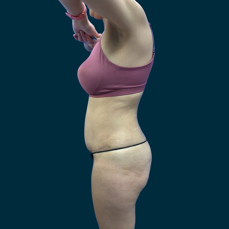 Abdominoplasty Before & After Gallery - Patient 310659 - Image 8
