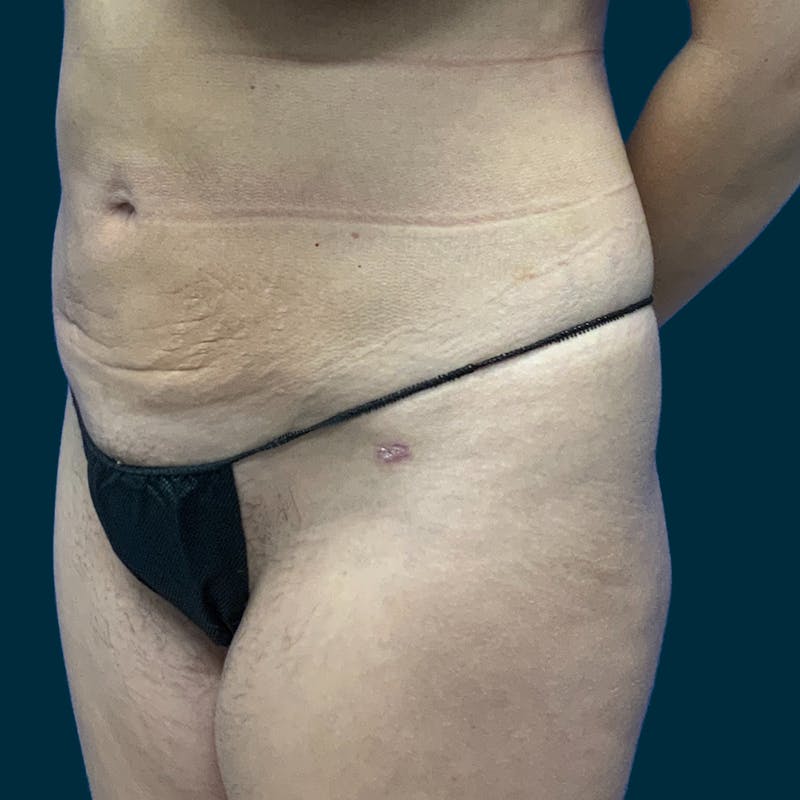 Liposuction Before & After Gallery - Patient 388935 - Image 4