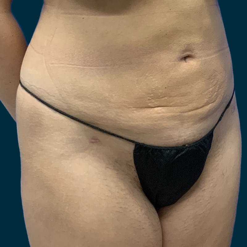 Liposuction Before & After Gallery - Patient 388935 - Image 6