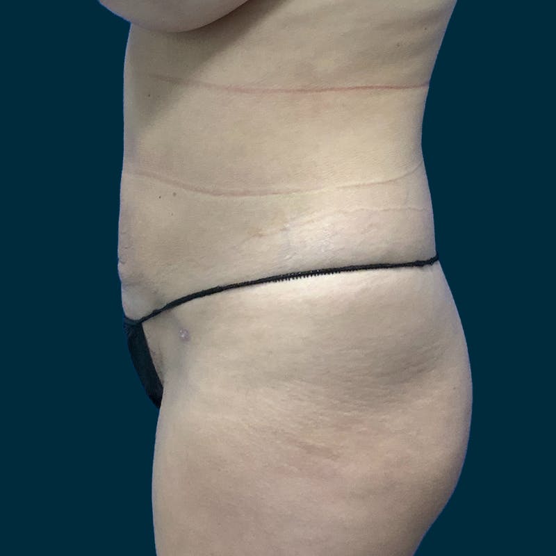Liposuction Before & After Gallery - Patient 388935 - Image 8