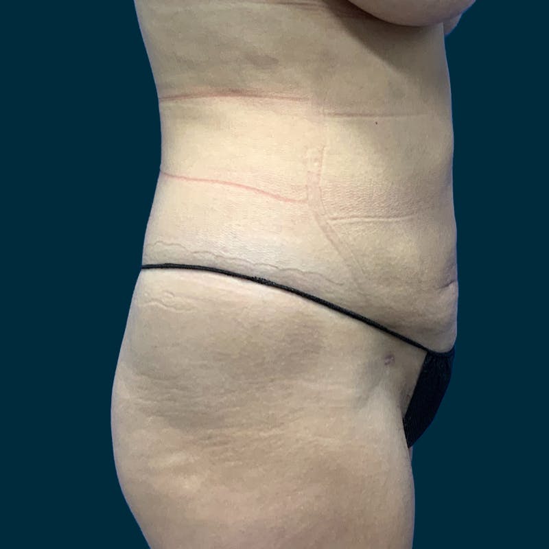 Liposuction Before & After Gallery - Patient 388935 - Image 10