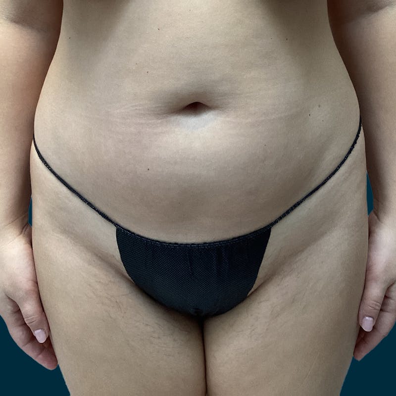 Liposuction Before & After Gallery - Patient 388935 - Image 1
