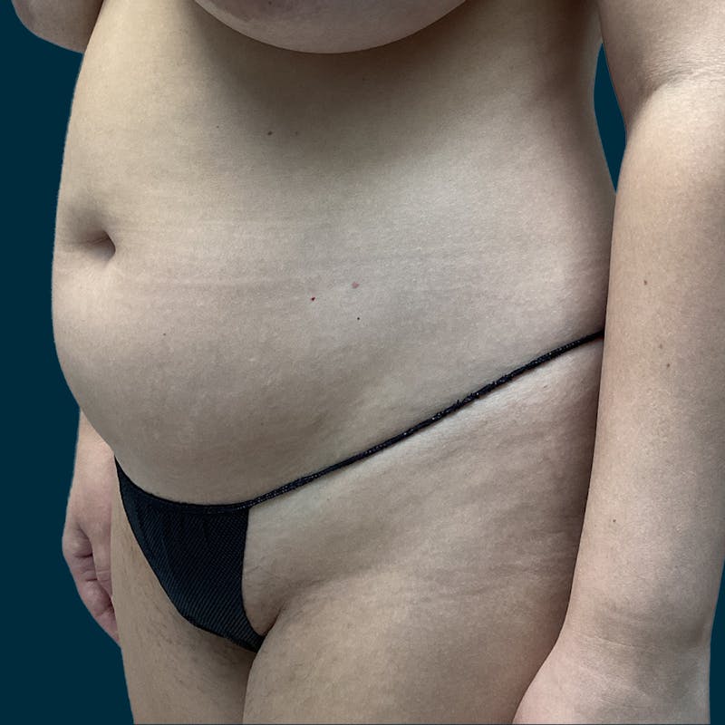 Liposuction Before & After Gallery - Patient 388935 - Image 3