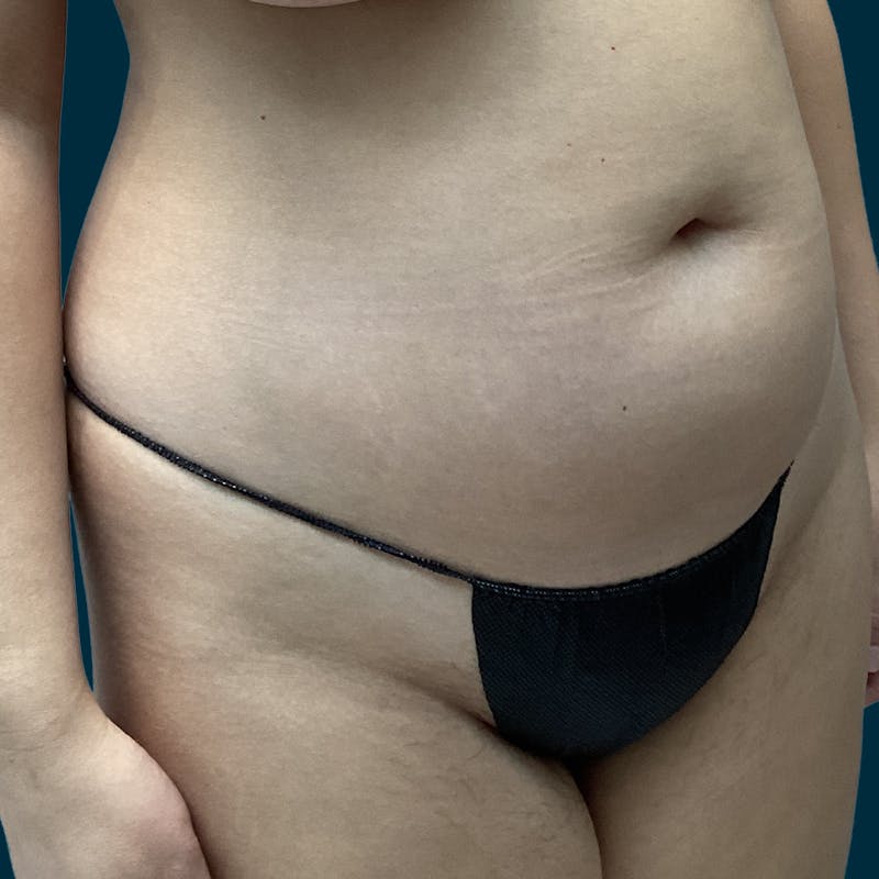 Liposuction Before & After Gallery - Patient 388935 - Image 5