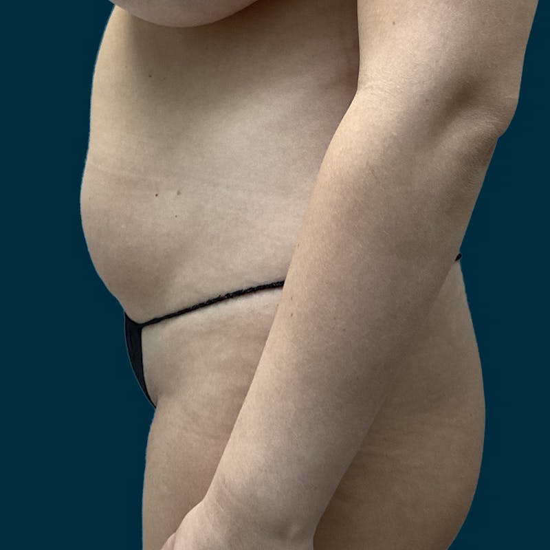 Liposuction Before & After Gallery - Patient 388935 - Image 7