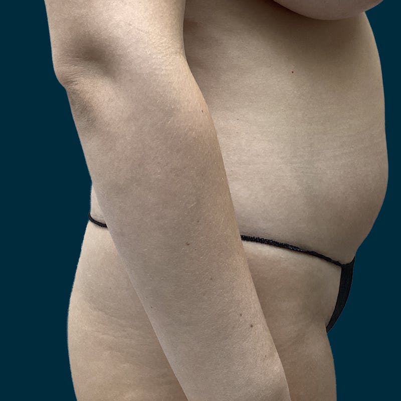 Liposuction Before & After Gallery - Patient 388935 - Image 9
