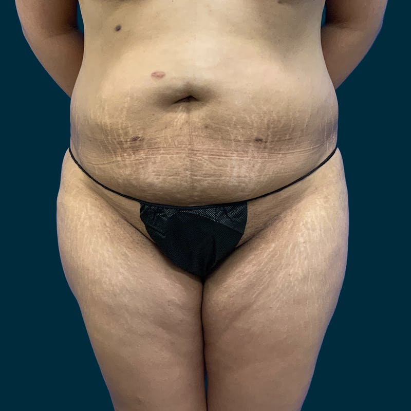 Fat Transfer Before & After Gallery - Patient 121189 - Image 1
