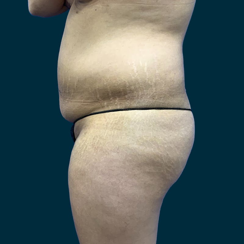 Fat Transfer Before & After Gallery - Patient 121189 - Image 3