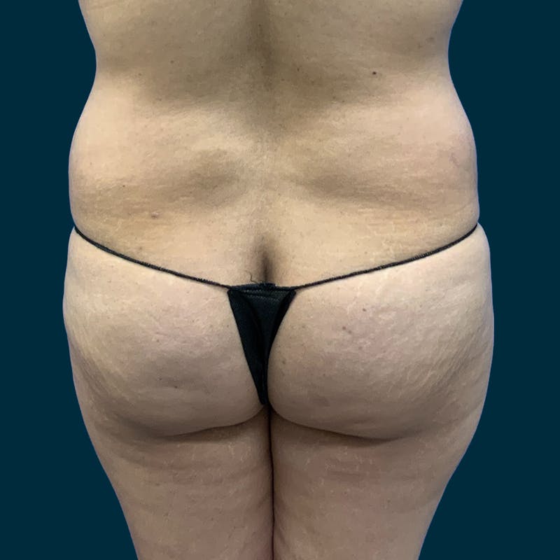 Fat Transfer Before & After Gallery - Patient 121189 - Image 9