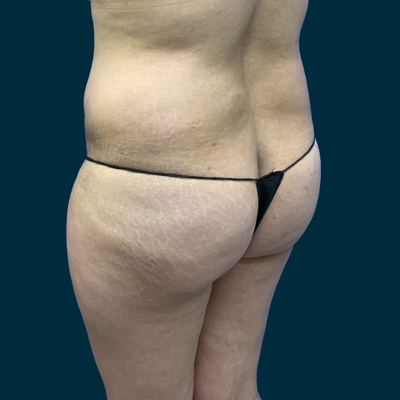 Fat Transfer Before & After Gallery - Patient 121189 - Image 7