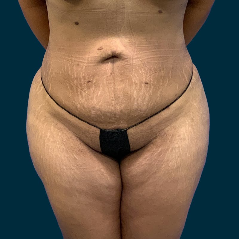 Fat Transfer Before & After Gallery - Patient 121189 - Image 2
