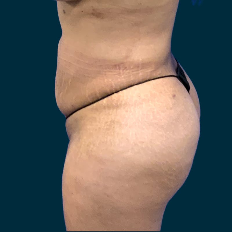 Fat Transfer Before & After Gallery - Patient 121189 - Image 4