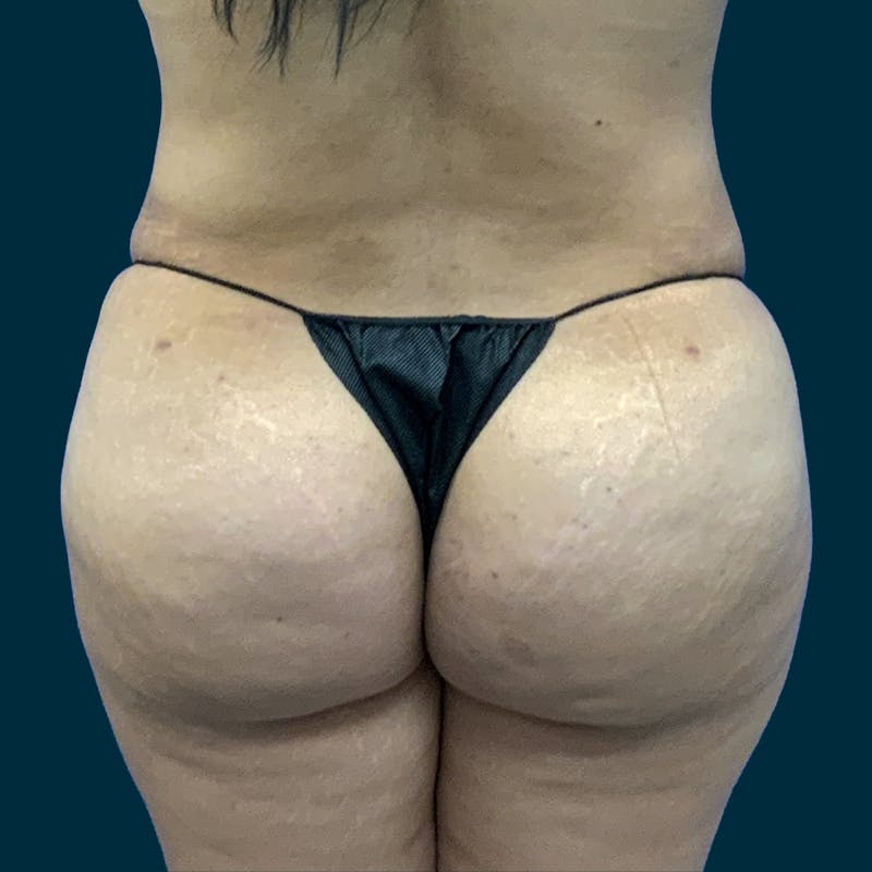 Fat Transfer Before & After Gallery - Patient 121189 - Image 10