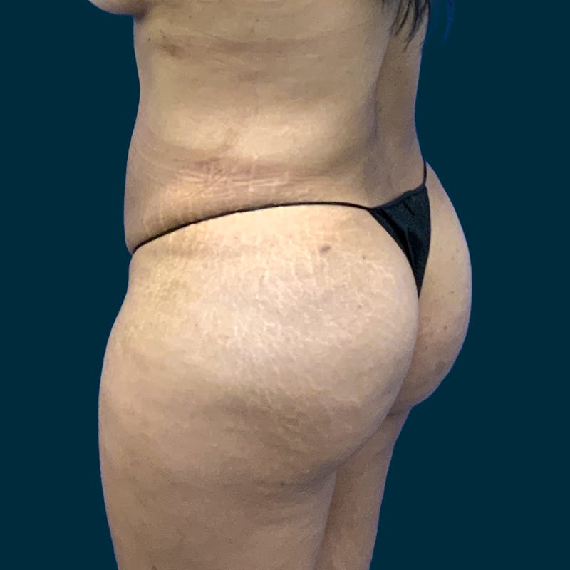 Fat Transfer Before & After Gallery - Patient 121189 - Image 8