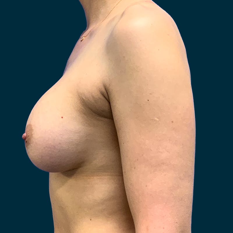 Breast Augmentation Before & After Gallery - Patient 366308 - Image 4
