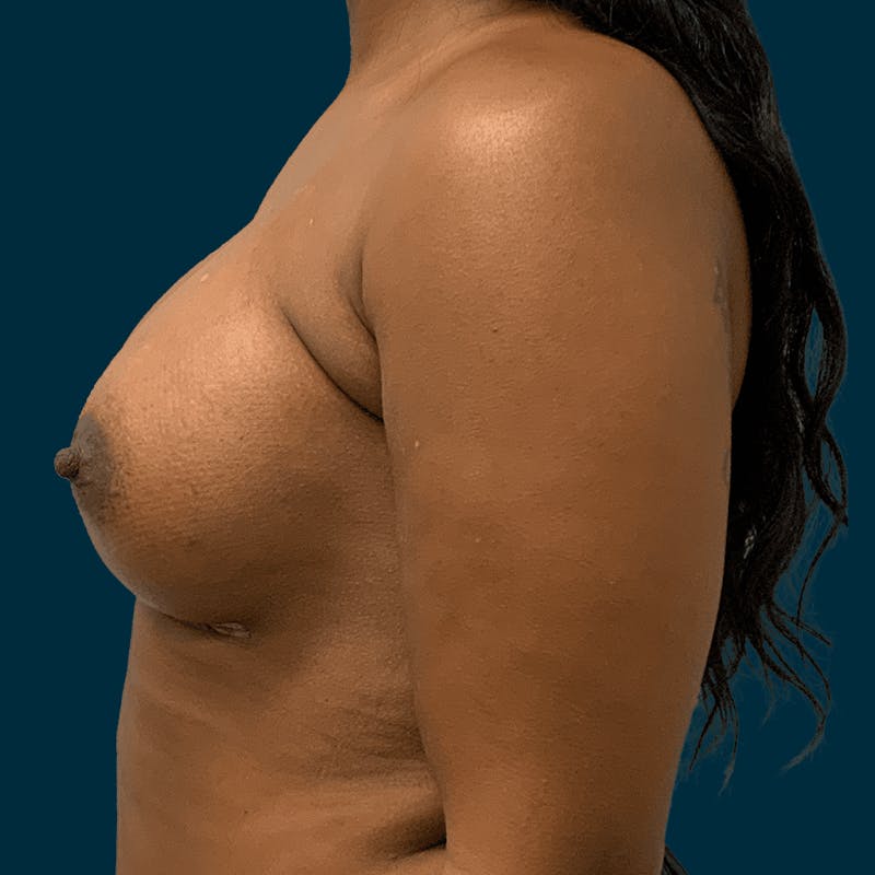 Breast Augmentation Before & After Gallery - Patient 474494 - Image 4