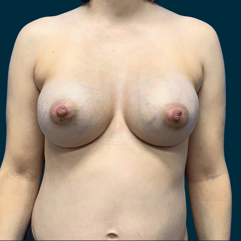 Breast Augmentation Before & After Gallery - Patient 336423 - Image 2
