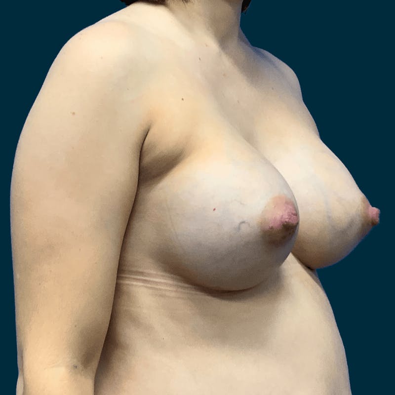 Breast Augmentation Before & After Gallery - Patient 336423 - Image 4