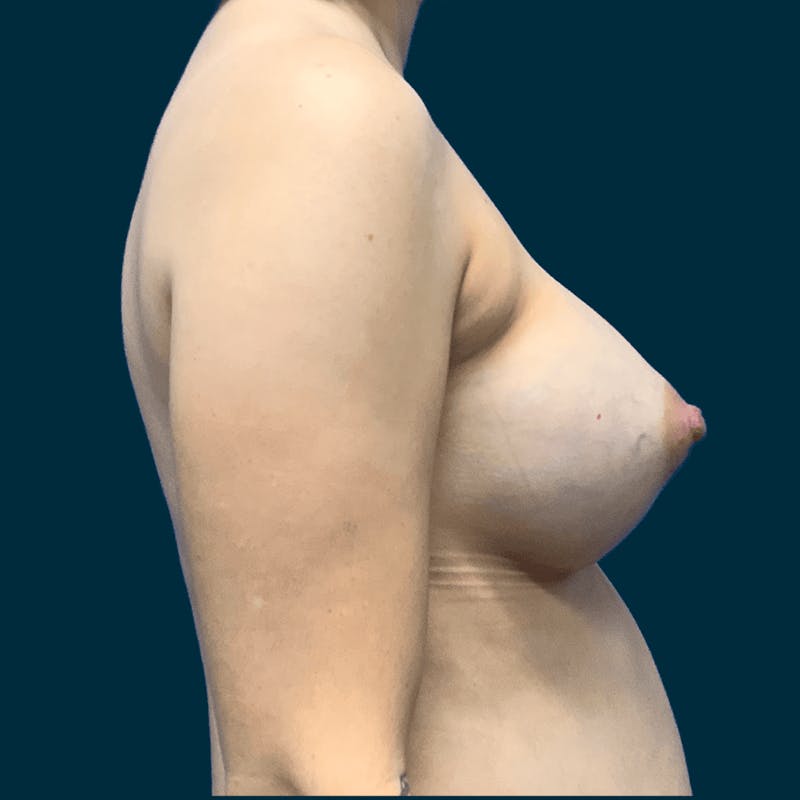 Breast Augmentation Before & After Gallery - Patient 336423 - Image 6