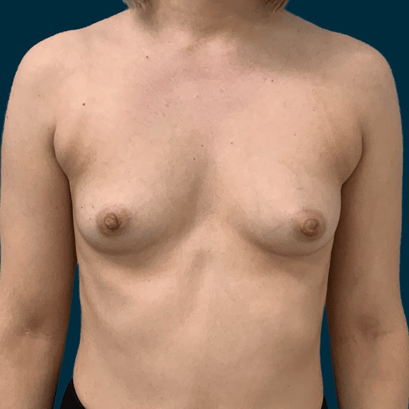 Patient OYBEdsVNRiSR7REP4xaBZw - Breast Augmentation Before & After Photos