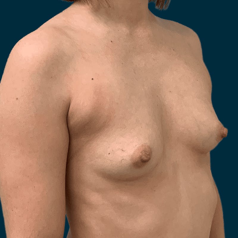Breast Augmentation Before & After Gallery - Patient 336423 - Image 3
