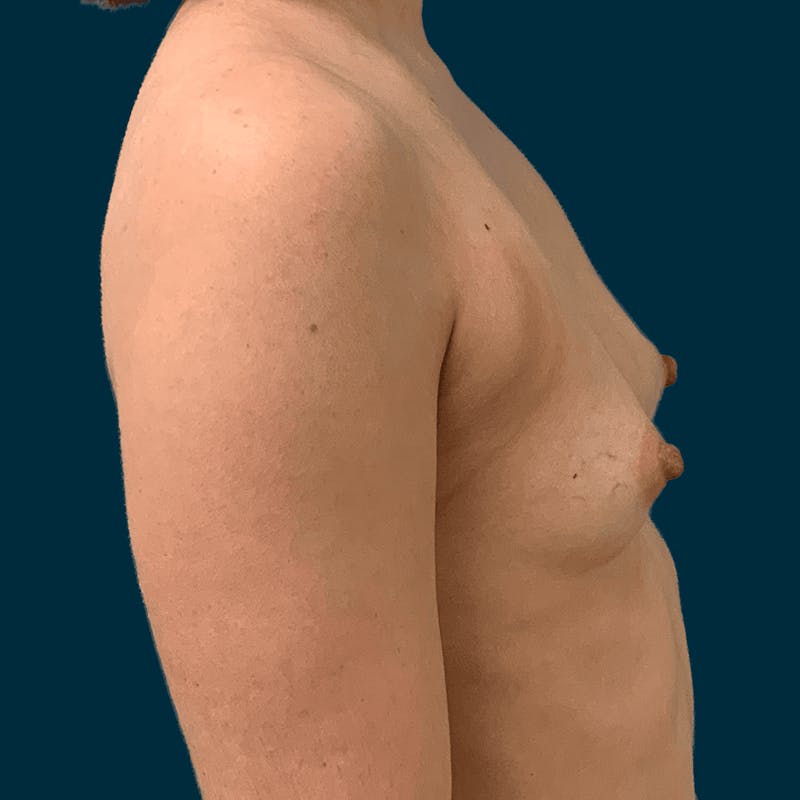 Breast Augmentation Before & After Gallery - Patient 336423 - Image 5