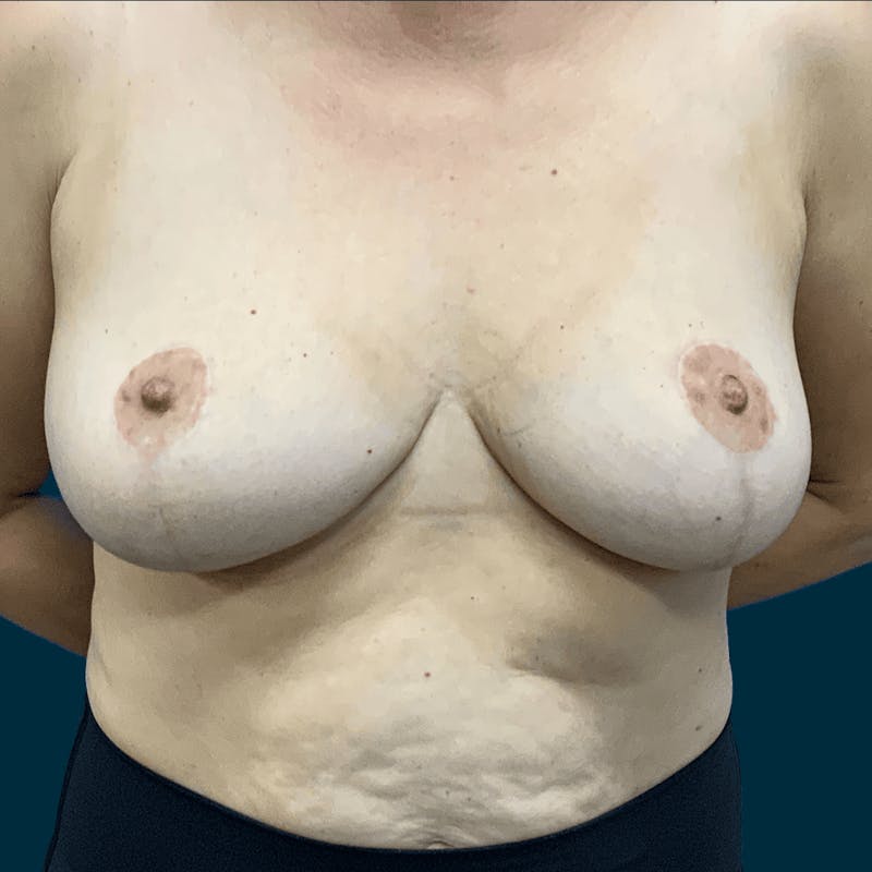 Breast Reduction Before & After Gallery - Patient 162604 - Image 2