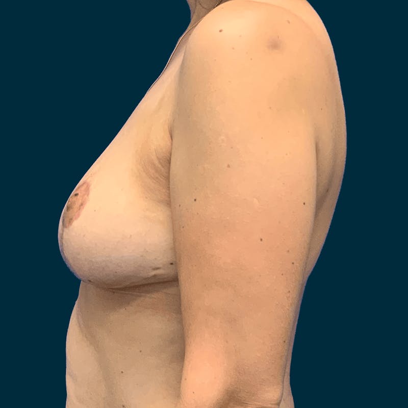 Breast Reduction Before & After Gallery - Patient 162604 - Image 6