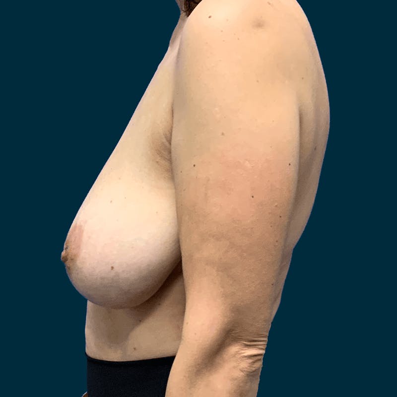 Breast Reduction Before & After Gallery - Patient 162604 - Image 5