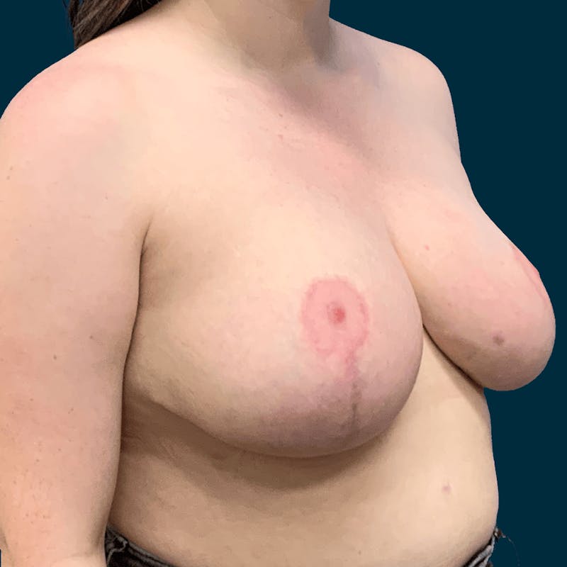 Breast Reduction Before & After Gallery - Patient 257403 - Image 4