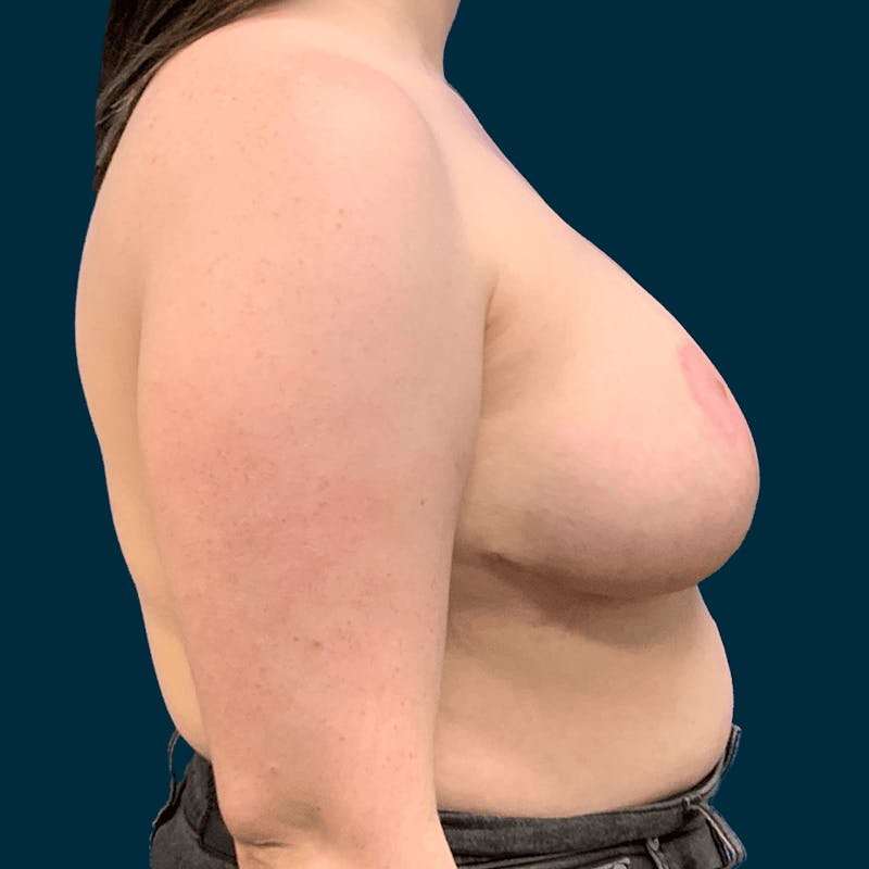 Breast Reduction Before & After Gallery - Patient 257403 - Image 6