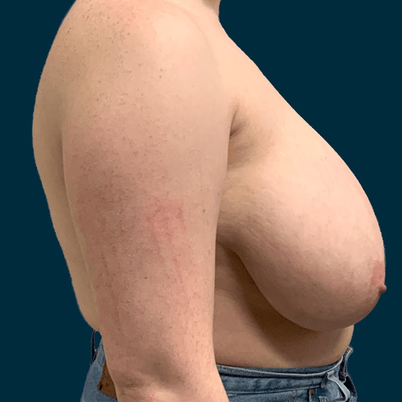 Breast Reduction Before & After Gallery - Patient 257403 - Image 5
