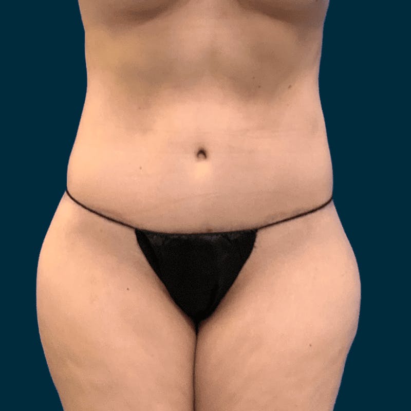 Body Lift Before & After Gallery - Patient 421627 - Image 2
