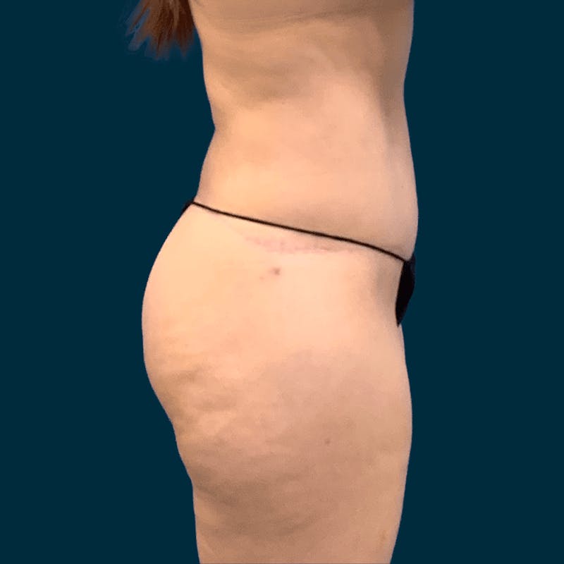 Body Lift Before & After Gallery - Patient 421627 - Image 4