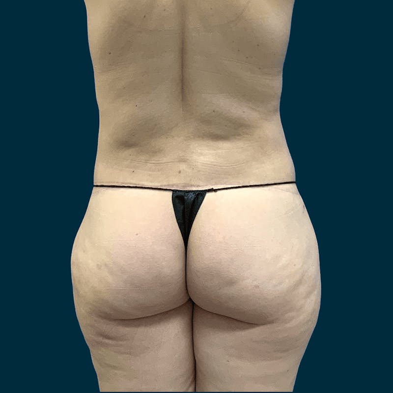 Body Lift Before & After Gallery - Patient 421627 - Image 6