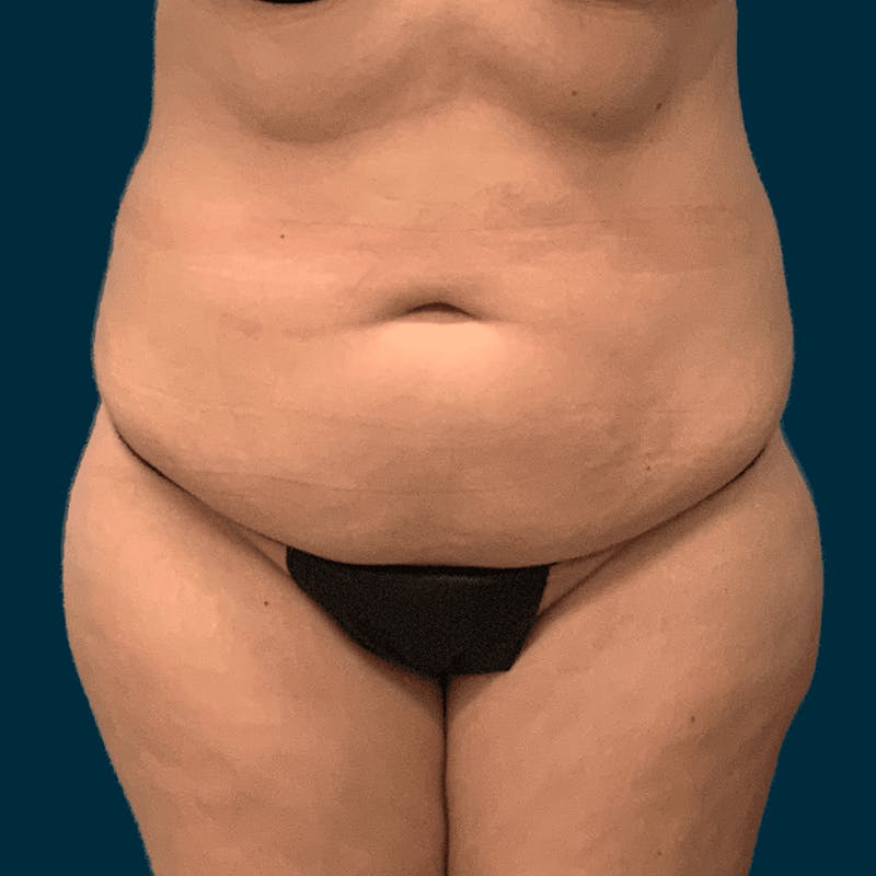 Body Lift Before & After Gallery - Patient 421627 - Image 1