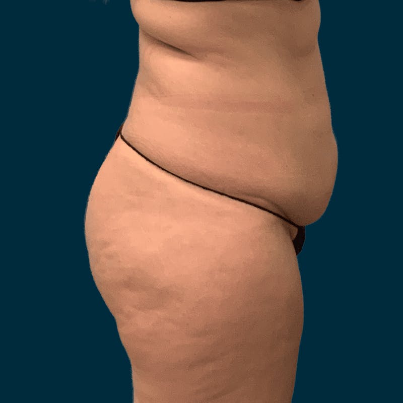 Body Lift Before & After Gallery - Patient 421627 - Image 3