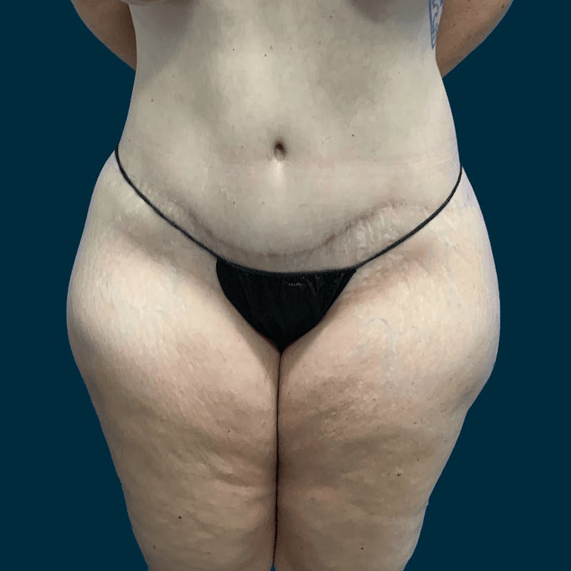 Body Lift Before & After Gallery - Patient 415350 - Image 2