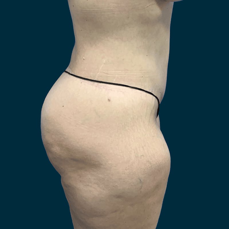 Body Lift Before & After Gallery - Patient 415350 - Image 4