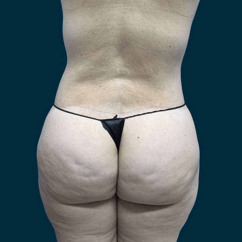Body Lift Before & After Gallery - Patient 415350 - Image 6